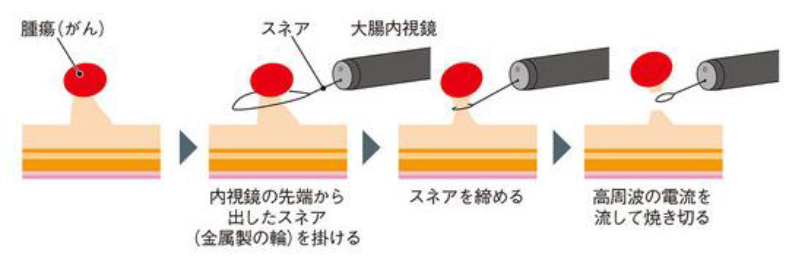ポリープの切除